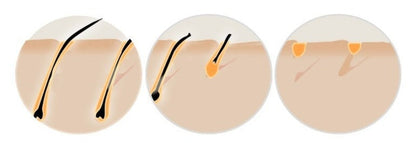 HexoSkin™ IPL-laserhårborttagningsenhet för hemmabruk