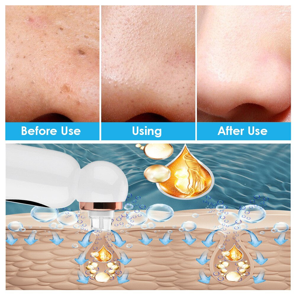 HexoSkin™ Hydrodermabrasion borttagare av pormaskar
